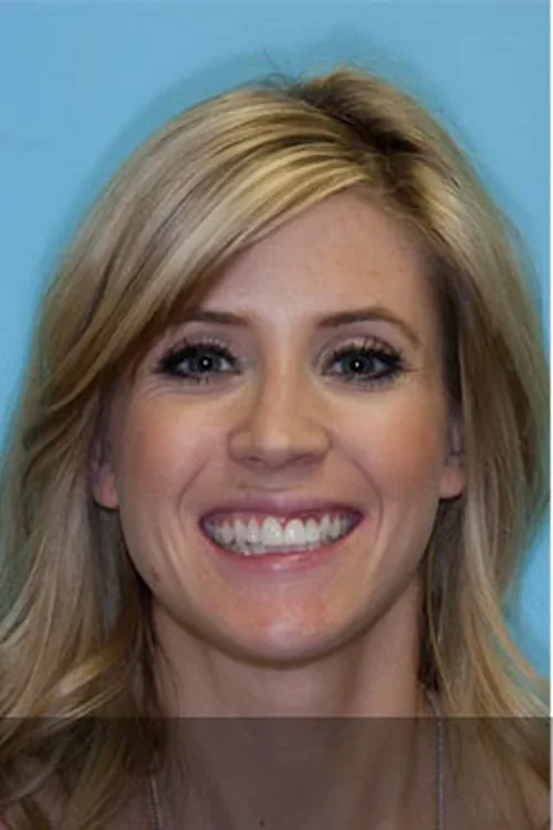 A patient's smile before porcelain veneers